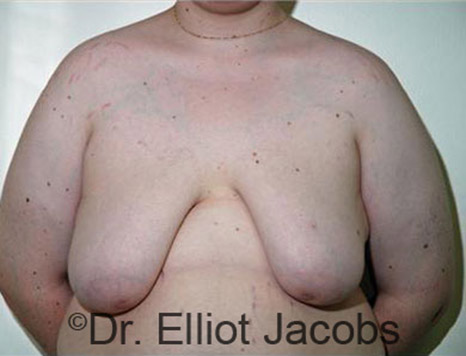 Men's breast, before Gynecomastia Adolescent treatment, front view - patient 17