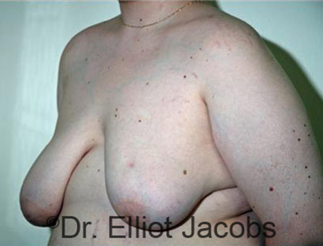 Men's breast, before Gynecomastia Adolescent treatment, oblique view - patient 17