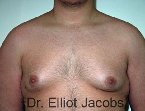 Men's breast, before Gynecomastia Adolescent treatment, front view - patient 18