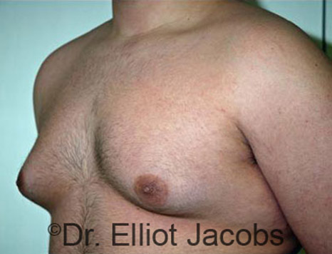 Men's breast, before Gynecomastia Adolescent treatment, oblique view - patient 18