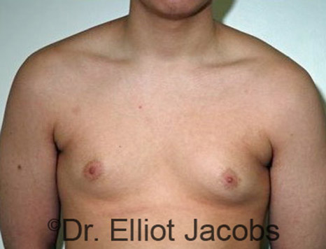 Men's breast, before Gynecomastia Adolescent treatment, front view - patient 19