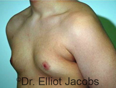 Men's breast, before Gynecomastia Adolescent treatment, oblique view - patient 19