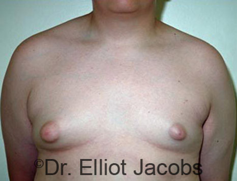 Male breast, before Adolescent Gynecomastia treatment, front view, patient 2