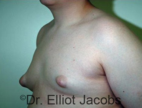 Men's breast, before Gynecomastia Adolescent treatment, oblique view - patient 20