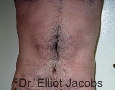 Male body, after Puffy Nipple Reduction treatment, front view, patient 2