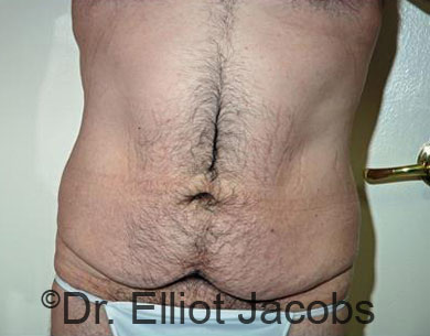 Male body, before Puffy Nipple Reduction treatment, front view, patient 2