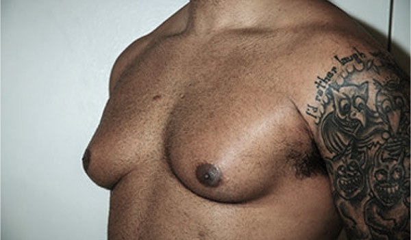 Male breast, before gynecomastia treatment, l-side oblique view, patient 35