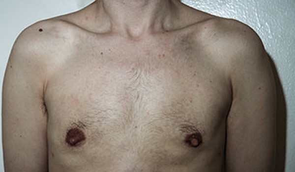 Male breast, after gynecomastia treatment, front view, patient 36