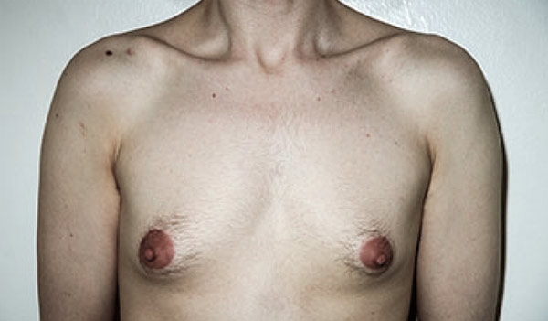 Male breast, before gynecomastia treatment, front view, patient 36