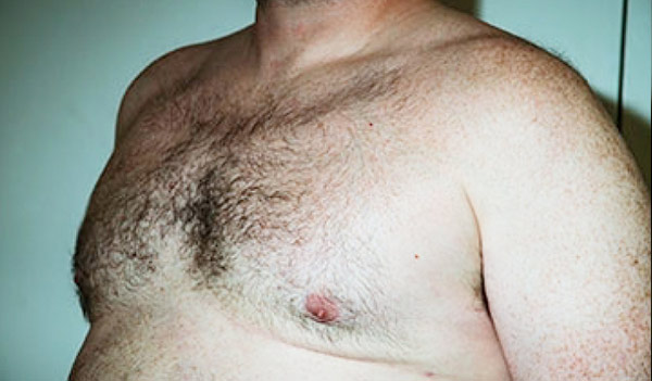 Before and After Patient37 Gynecomastia Surgery