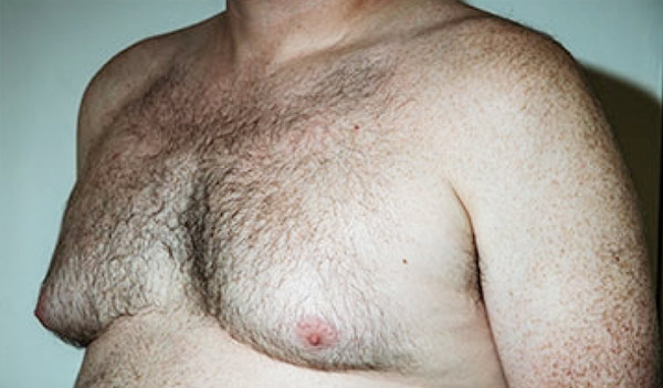 Male breast, before gynecomastia treatment, l-side oblique view, patient 37