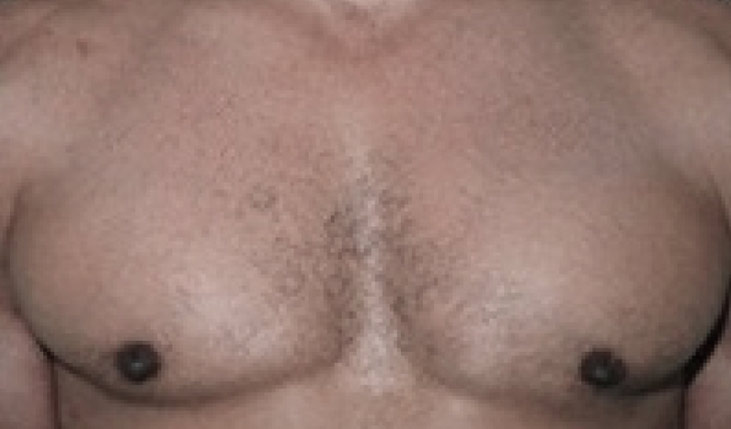 Male breast, after gynecomastia treatment, front view, patient 38