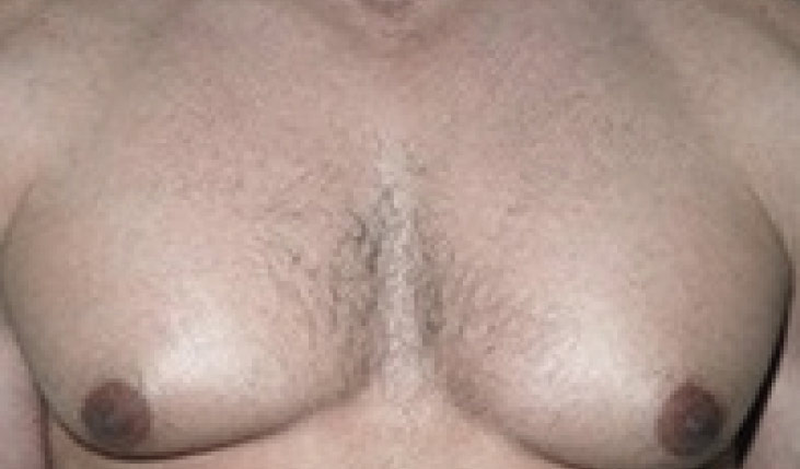 Male breast, before gynecomastia treatment, front view, patient 38