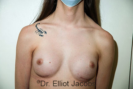 Male breast, after Male to Female Top Surgery treatment, front view, patient 1