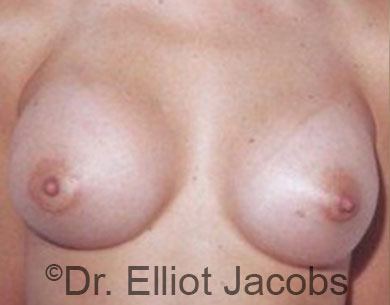 Male breast, after Male to Female Top Surgery treatment, front view, patient 2
