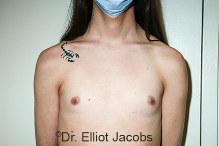 Male breast, before Male to Female Top Surgery treatment, front view, patient 1