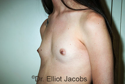 Male breast, before Male to Female Top Surgery treatment, oblique view, patient 1