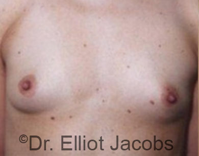 Male breast, before Male to Female Top Surgery treatment, front view, patient 2