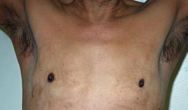 Male breast, after Revision Gynecomastia Surgery, front view, patient 1