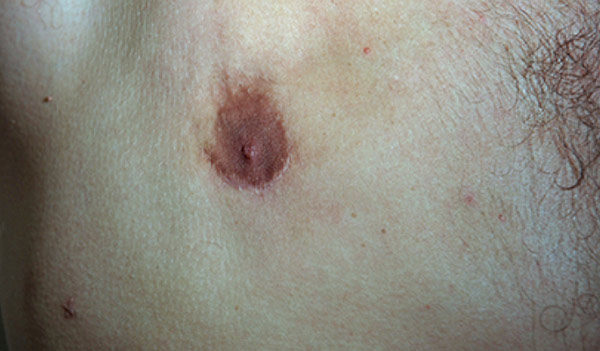Male nipple, after Revision Gynecomastia Surgery, front view, patient 2