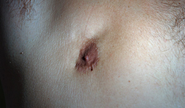 Male nipple, before Revision Gynecomastia Surgery, front view, patient 2