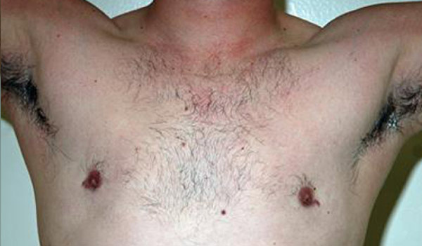 Male breast, after Revision Gynecomastia Surgery, front view, patient 3
