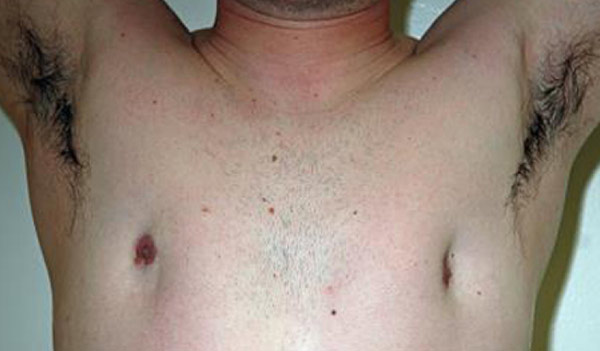 Male breast, before Revision Gynecomastia Surgery, front view, patient 3