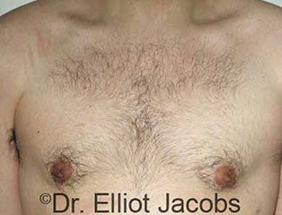 Male breast, after gynecomastia treatment, front view, patient 2
