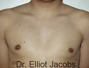 Male breast, after gynecomastia treatment, front view, patient 1