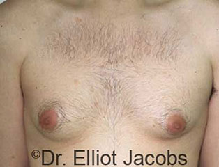 Male breast, before gynecomastia treatment, front view, patient 2